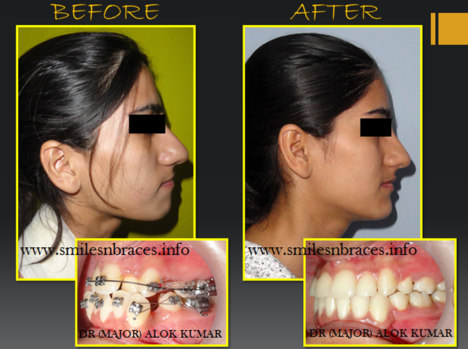 overbite before and after profile